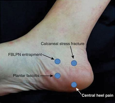 Calcaneal Stress Fracture Squeeze Test