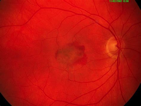 Wet Amd Macular Degeneration Indianapolis | Retina Treatment