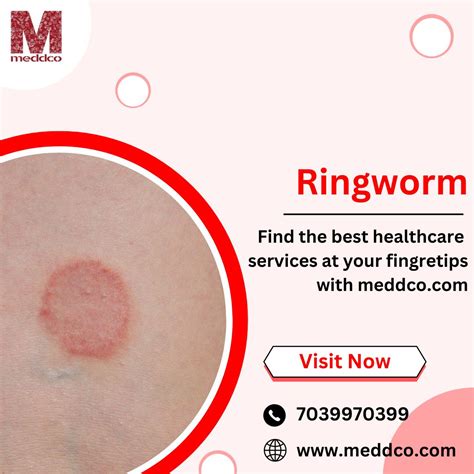 Ringworm In Humans Treatment