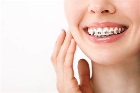 Image result for braces