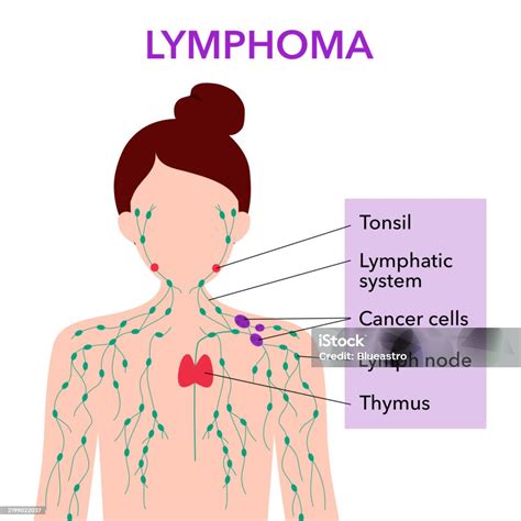 Anatomy Of Lymph Node With Cancer Cells In Woman Silhouette Lymphoma Cancer Concept Swollen ...
