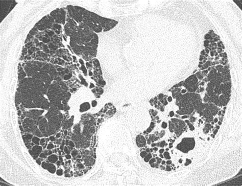Treatment outcomes of the interstitial lung disease subtype of ...