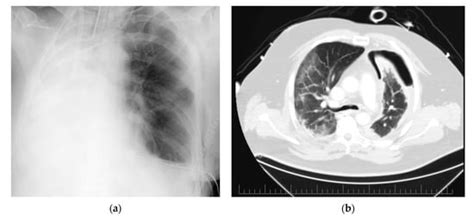 Extracorporeal Membrane Oxygenation Use in Thoracic Surgery