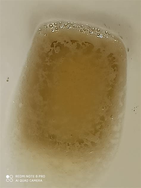 Bubbles In Urine That Go Away at Susan Cummings blog