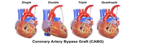 Coronary Artery Bypass Graft In Juba, Coronary Artery Bypass Graft ...