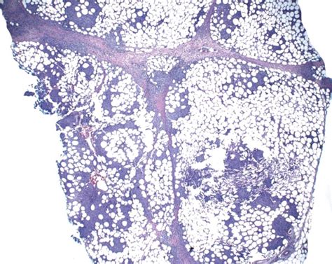 以肉芽肿为显著特征的皮下脂膜炎样T细胞淋巴瘤一例-资讯-华夏病理网