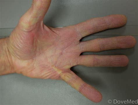 Dupuytren’s Contracture