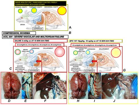 Acute Compartment Syndrome and Intra-Abdominal Hypertension ...