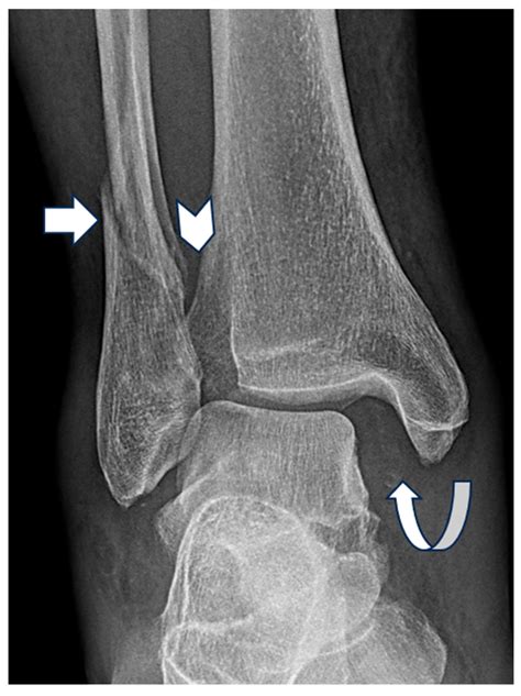 Correlation Between Weber Classification of Ankle Fractures and Medial Clear Space Widening on ...