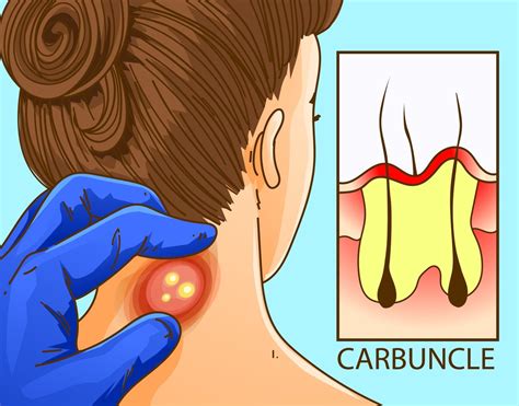 Carbuncle Core 的图像结果