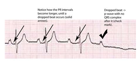 Wenckebach Heart Block