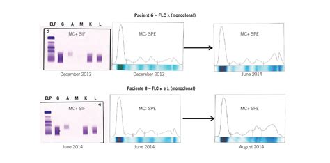 Electrophoresis Multiple Myeloma