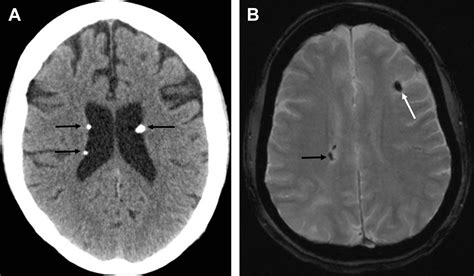 Cross-sectional Imaging Review of Tuberous Sclerosis - Radiologic Clinics