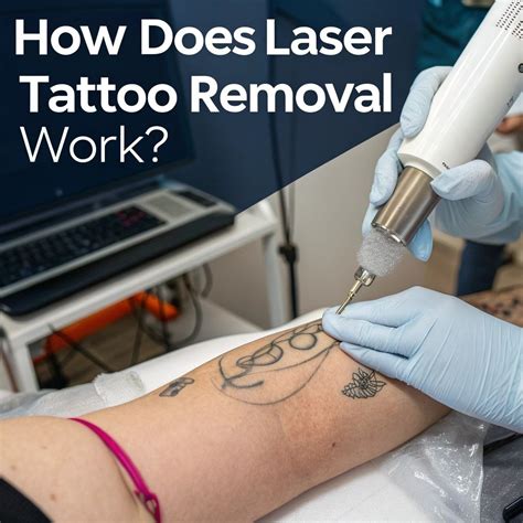 How does laser tattoo removal work?