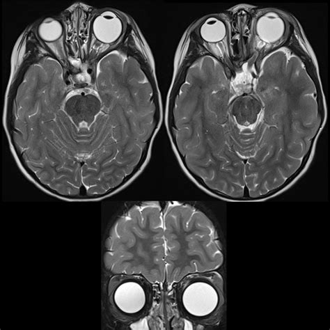 Optic Nerve Glioma