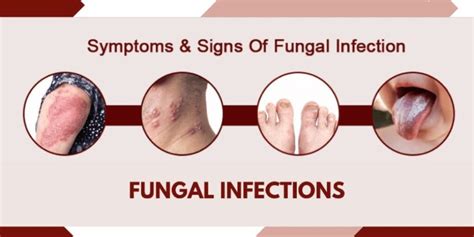 Fight fungal infections- Ayurvedic medicine for fungal infection ...