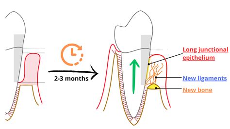 That’s how gums reattach to teeth after deep cleaning