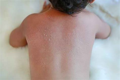 Harlequin Ichthyosis - Gejala, Penyebab, dan Pengobatan - Alodokter