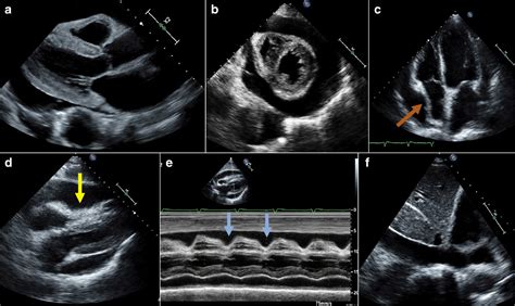 Cardiac Tamponade Echo