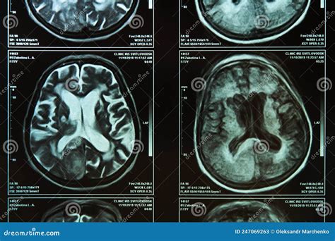 A Fragment of an Image of an Elderly Person S Brain Scan on Magnetic Resonance Imaging MRI Film ...