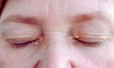 Carbon dioxide Laser Excision: A Promising Minimally Invasive Treatment ...