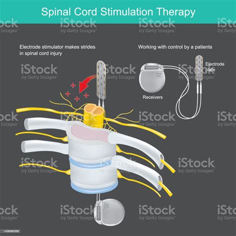 Spinal Cord Stimulation Therapy A Electronic Tool Implant In Body Use For Neck And Back Pain ...