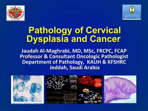 Carcinoma of cervix pathology | PDF