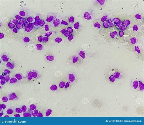 Blast Cells In Blood