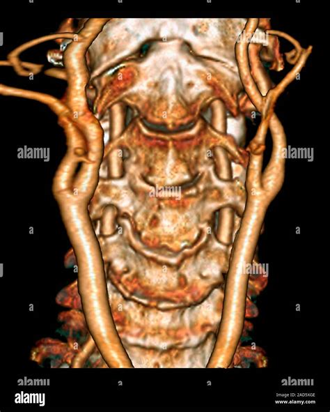 Cervical spine and arteries. Coloured 3D computed tomography (CT) scan ...