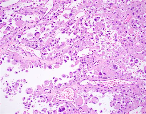 Alveolar Soft Part Sarcoma