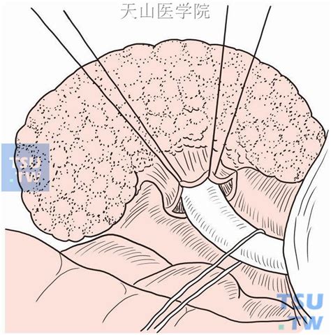 【图】胰腺瘘管空肠吻合术 - 外科手术学 - 天山医学院