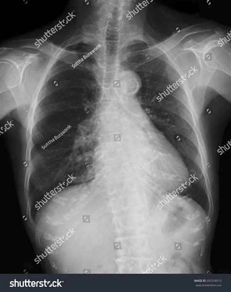 Acute Bronchitis X Ray