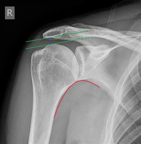 X Ray Normal Shoulder