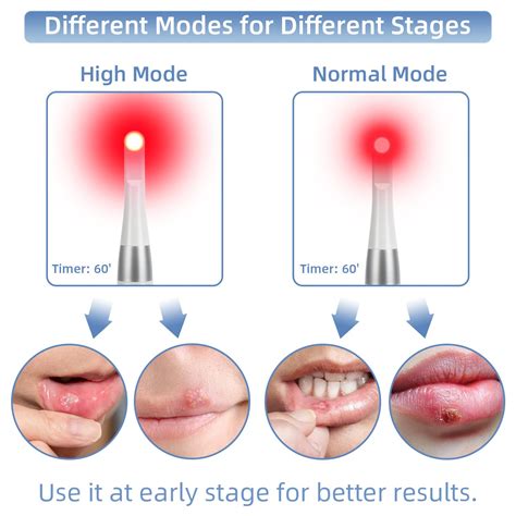 Canker Sore Stages Stages Of Cold Sores & How To Treat Fever Blisters