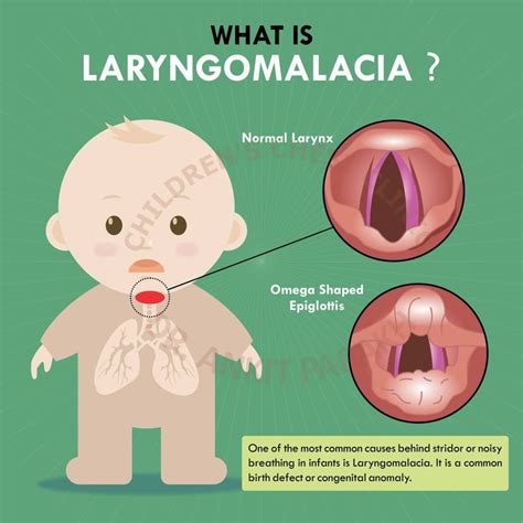 What is laryngomalacia? – Dr. Ankit Parakh – India's best Pediatric ...