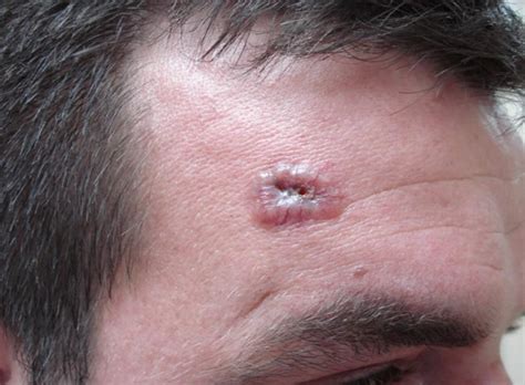 Basal Cell Carcinoma Beginning at Julius Peterkin blog