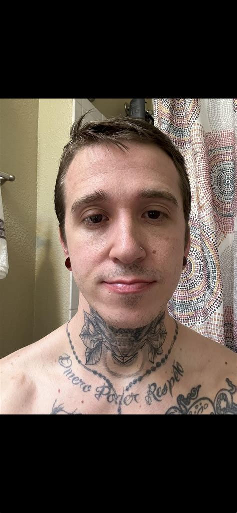 3 months post-op DJS (details in comments) : r/jawsurgery