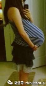 女子怀多胞胎，光肚子就重达100多斤，数量多到连医师都不敢相信