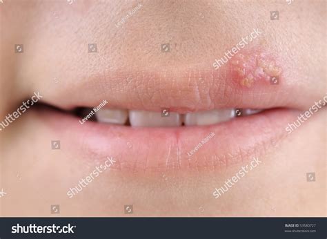 Close Up Of Lips Affected By Herpes. Stock Photo 53580727 : Shutterstock