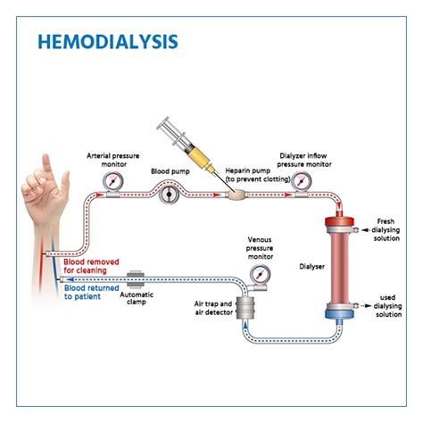 Hemodiálisis: pasos, procedimiento y recuperación
