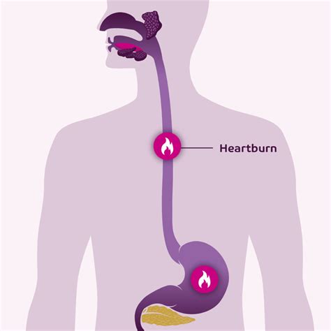Heartburn Chest Pain Location at Marie Renda blog