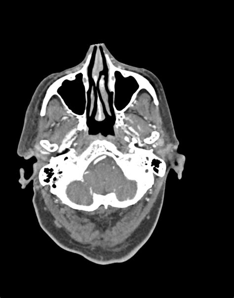 Carotid cavernous fistula (Radiopaedia 73719-84516 A) - NC Commons