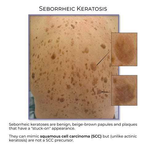 Seborrheic Keratosis Seborrheic Keratosis Clinical Pathology