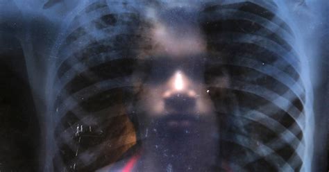 The Gendered Delay in the Diagnosis and Treatment of Tuberculosis ...