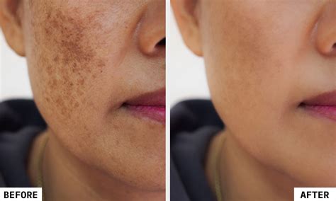 Q Switch Laser Treatment in India - Cost and Process