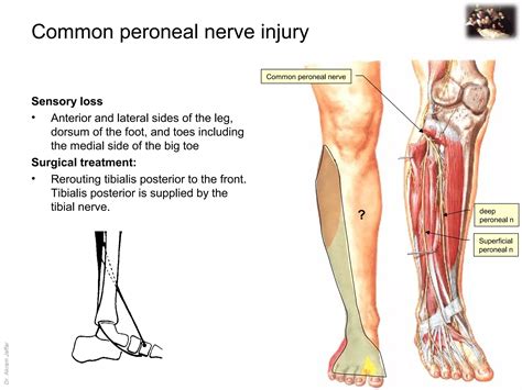 Applied anatomy common peroneal nerve injury | PPT