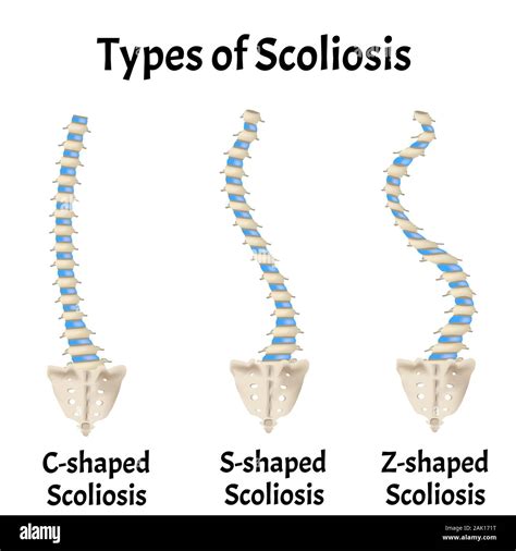 Types of Scoliosis. C, S, Z shaped scoliosis. Dextroscoliosis ...