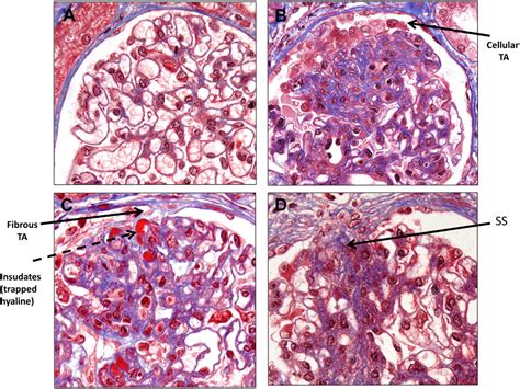 Focal Glomerulosclerosis Kidney Disease