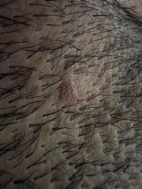 Genital warts? : r/DermatologyQuestions