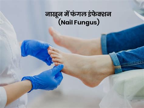 Nail Fungus Causes: Know About Symptoms And Treatment of Nakhun Mein ...